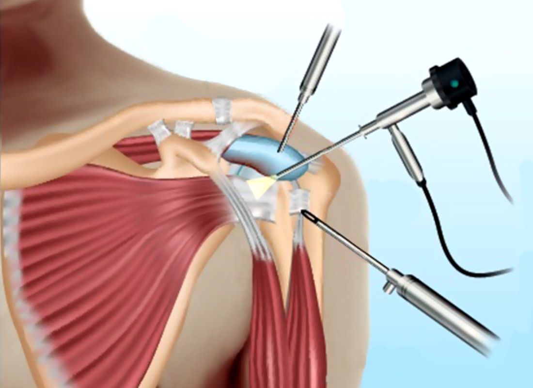 artroscopia de hombro guadalajara