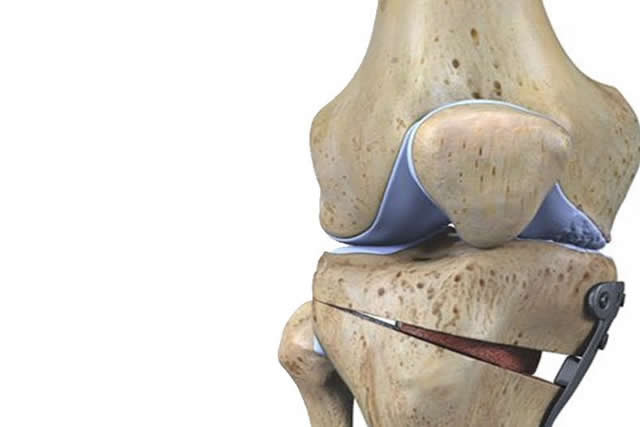 Osteotomía de rodilla