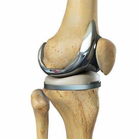 Prótesis Rodilla