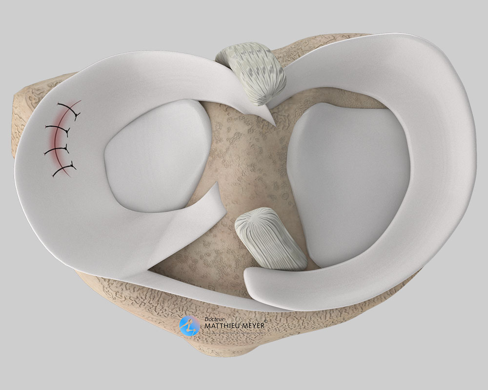 Sutura de menisco