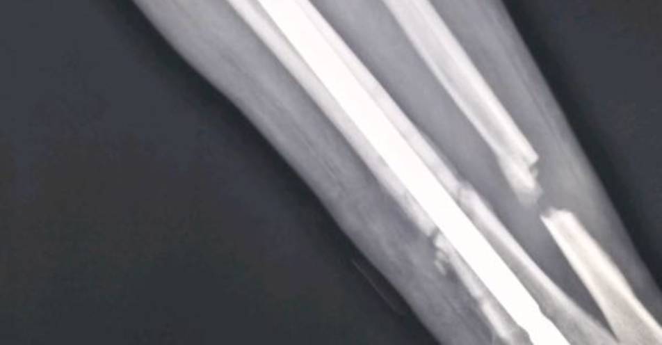 Atención de emergencias para fracturas