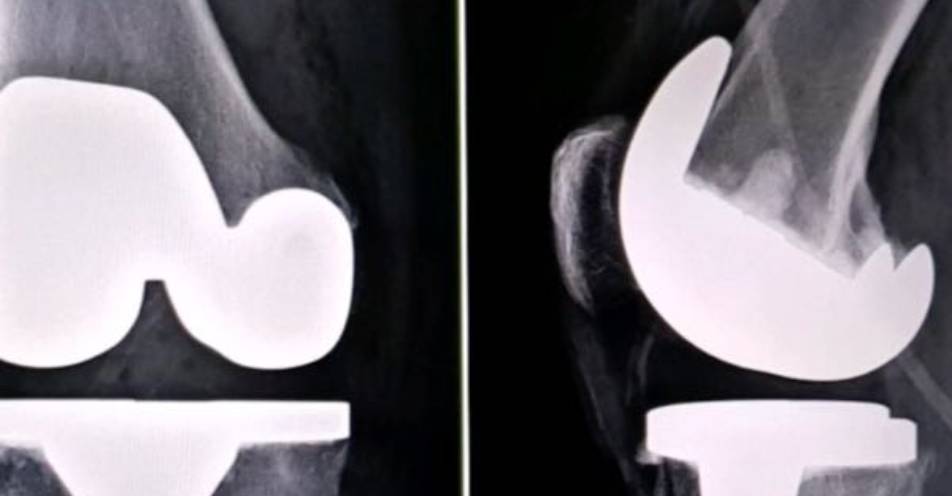 reemplazos articulares